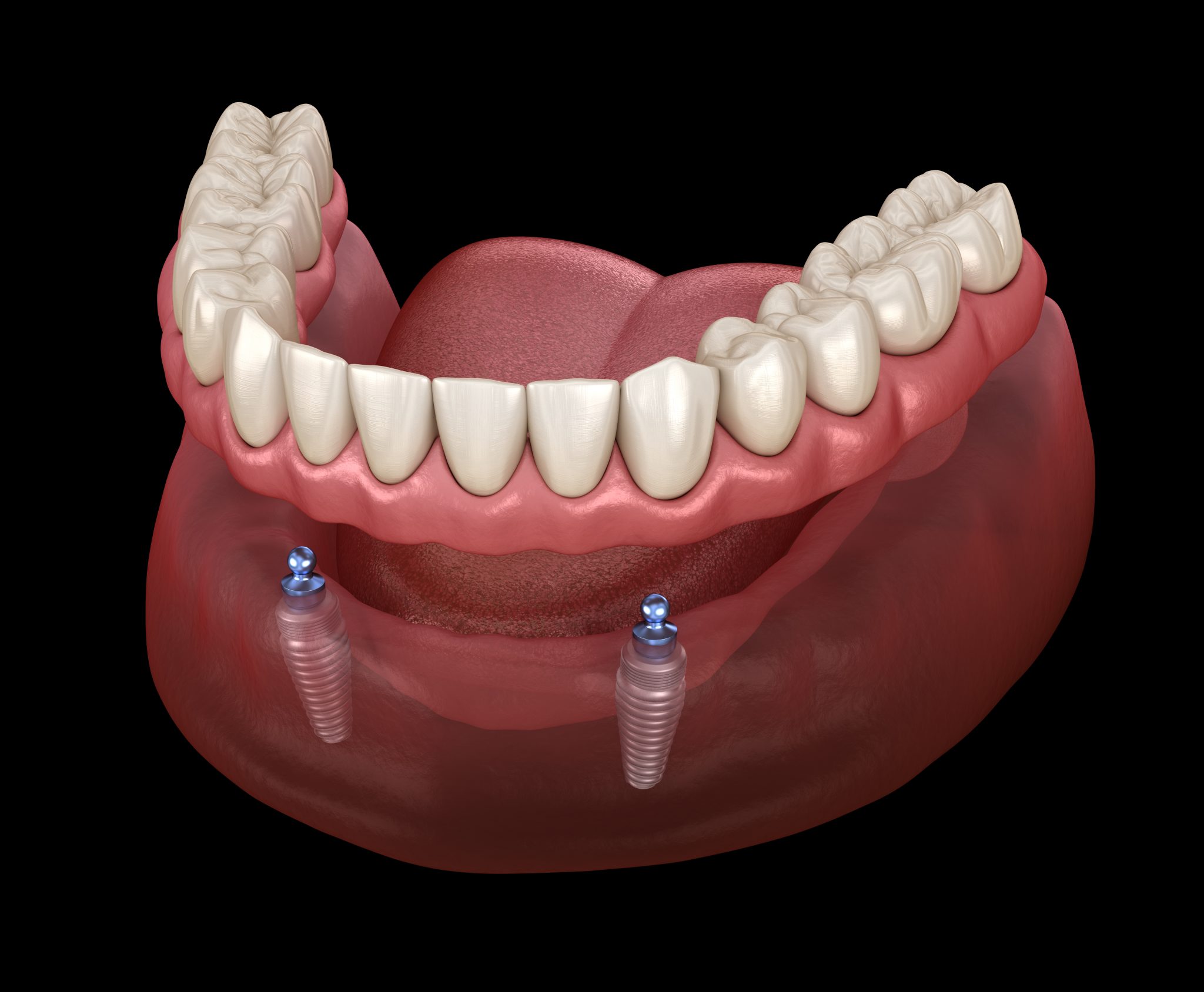 Fixed vs. Removable Implant Solutions