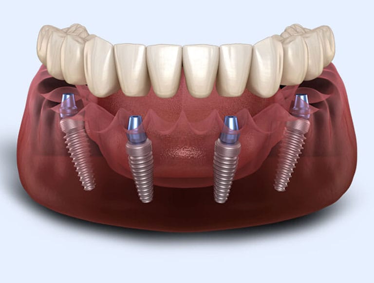 The All-On-4® Technique