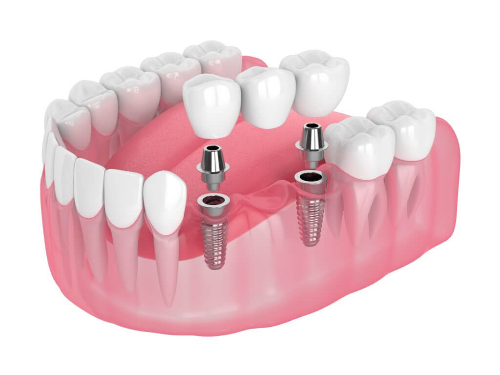 6-8 Implants